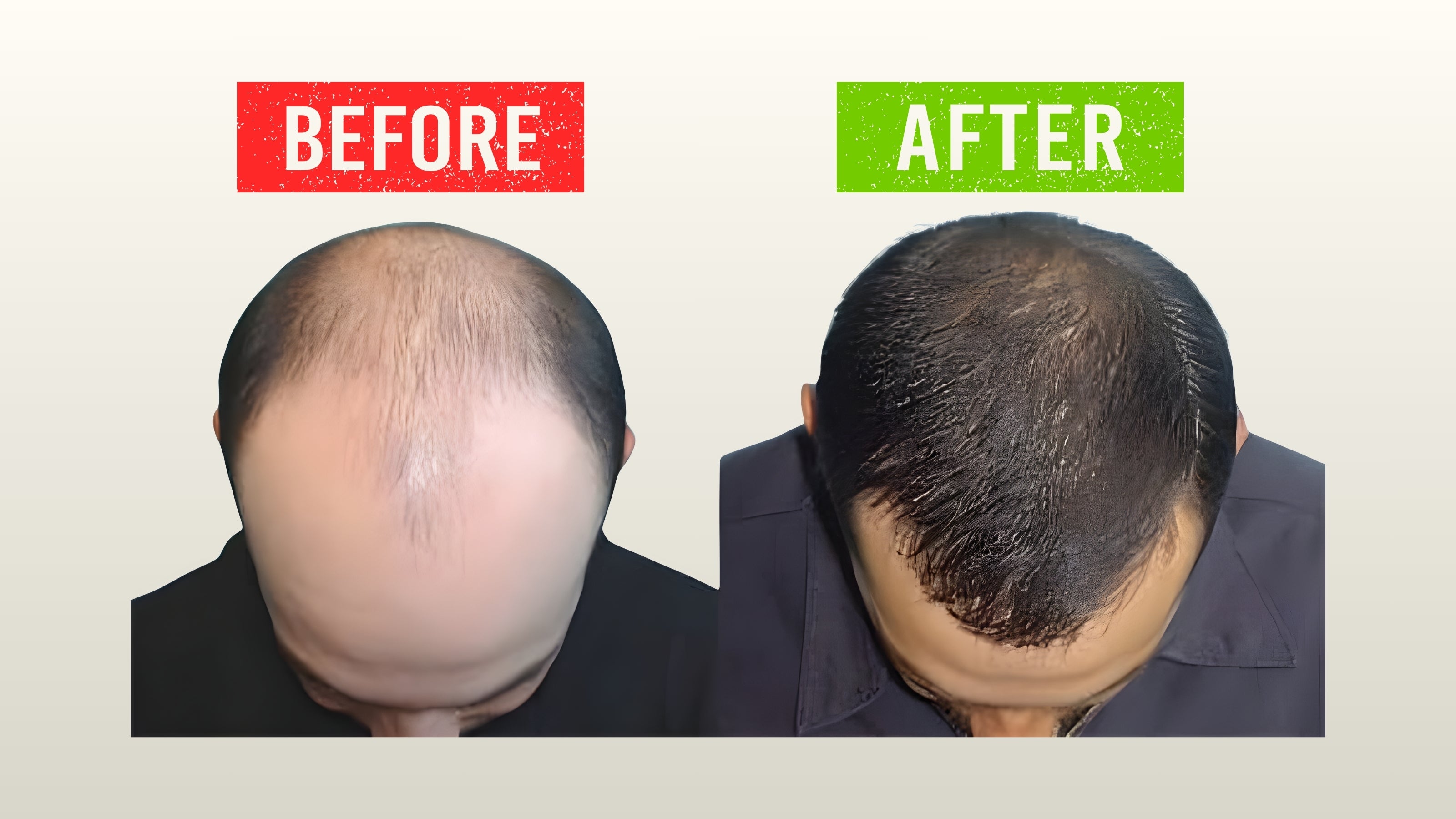 Before and after hair growth results showing reduced baldness and thicker hair using AX Hair Tonic and AX Amla Hair Oil