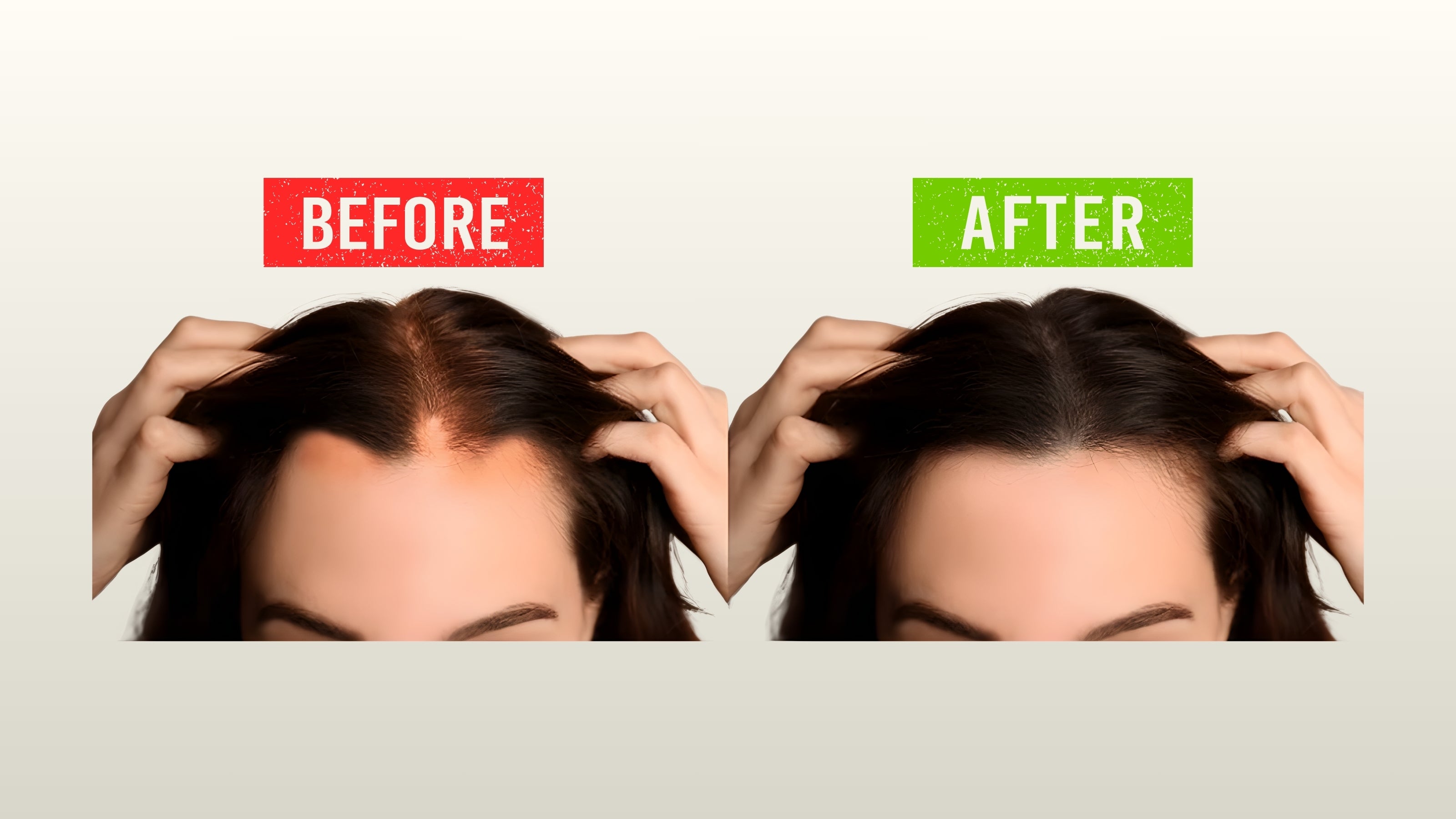 Before and after hair growth showing improved hairline with reduced thinning and fuller front hair using AX Hair Tonic and AX Amla Hair Oil