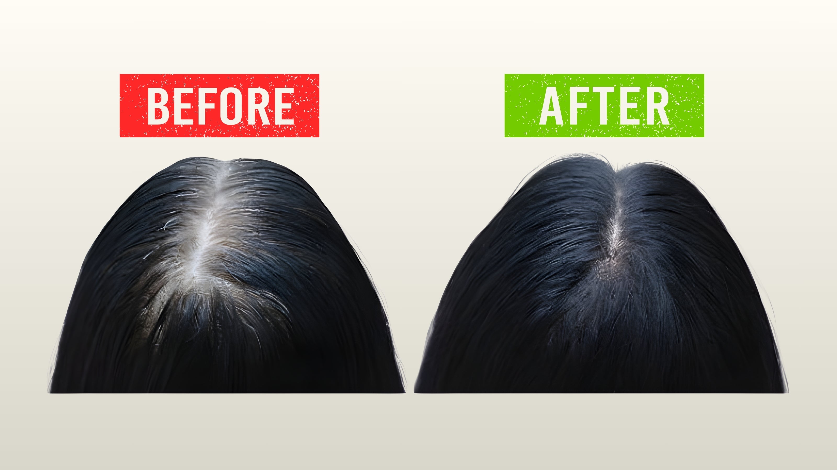 Before and after hair growth showing reduced hair thinning at center scalp with thicker, fuller hair using AX Hair Tonic and AX Amla Hair Oil